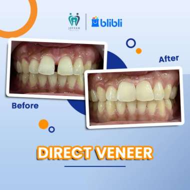 JOYFAM - DIRECT VENEER GIGI