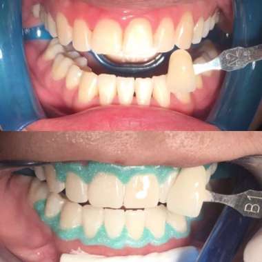 Teeth Whitening / Bleaching